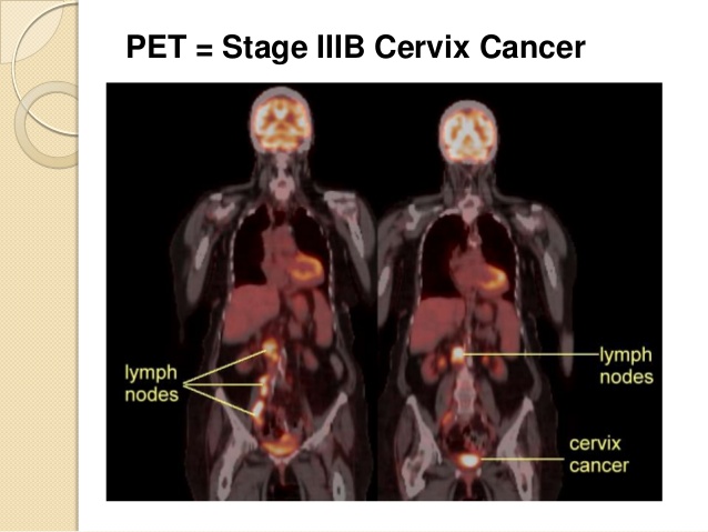 cervical cancer PET CT 2