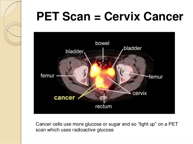 cervical cancer PET CT